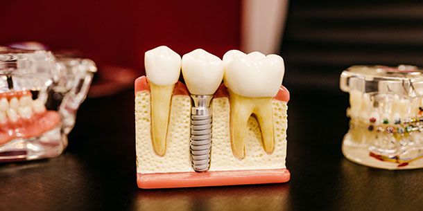 ?p=image&amp;src=%7B%22file%22%3A%22images%2FLaboratorio%2Fprotesis-dental Instituto Tecnol&oacute;gico de Santo Domingo - Laboratorios