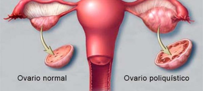 ?p=image&amp;src=%7B%22file%22%3A%22images%2Fnews%2FOvarios+Poliquisticos Instituto Tecnol&oacute;gico de Santo Domingo - Notas de prensa