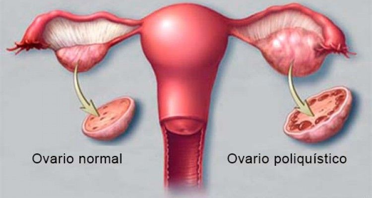 Ovarios%20Poliquisticos-63350062 image Ovarios%20Poliquisticos-63350062 Instituto Tecnológico de Santo Domingo - Vinculan Síndrome de ovario poliquístico a la infertilidad, la obesidad y la diabetes